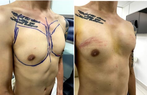 implantes pectorales en lima