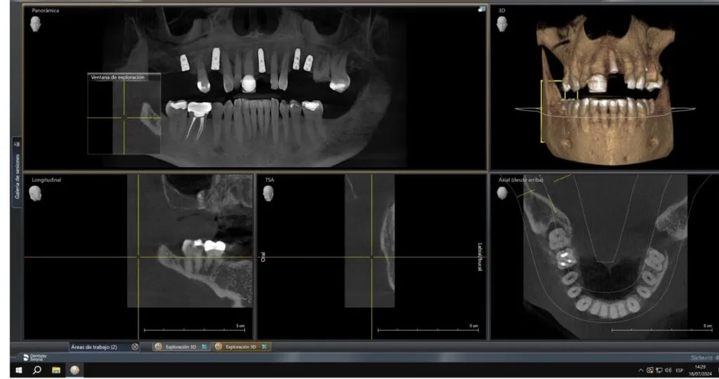 Implantes Dentales a Bajo Costo en Lima