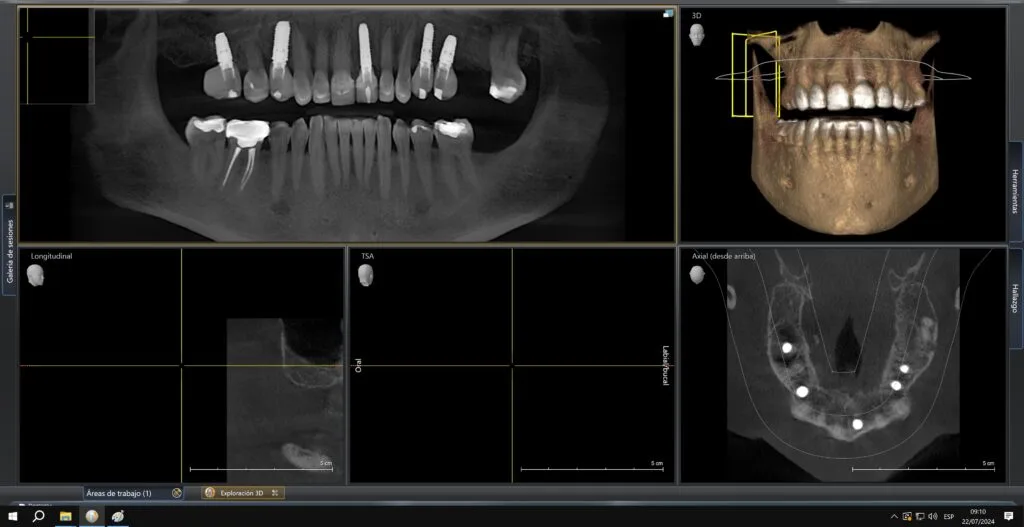 Implantes Dentales a Bajo Costo en Lima