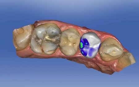 CEREC 3D CAD CAM Lima Peru