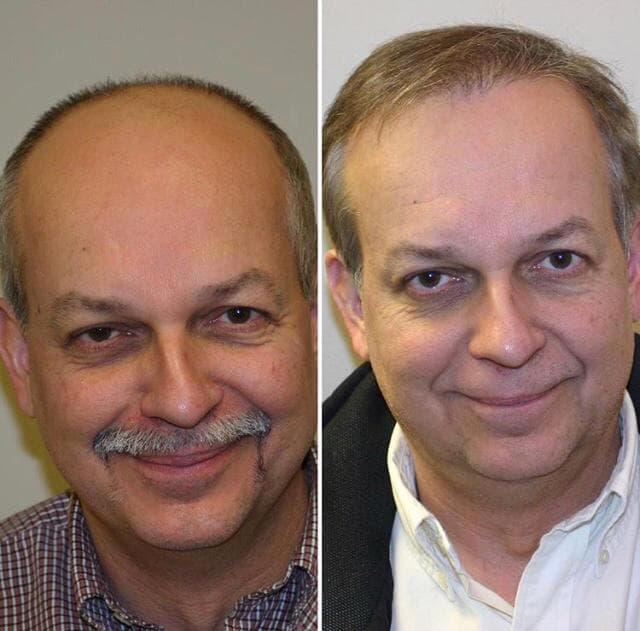 Hair Transplants Lima Peru
