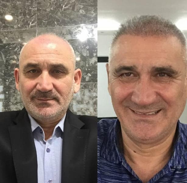 Hair Transplants in Lima Peru