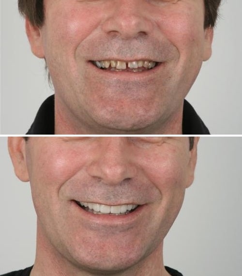 diseño de sonrisa hombres