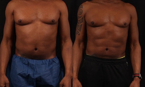 marcación abdominal lima