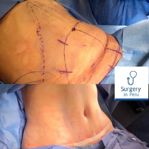 LipoAbdominoplasty lima