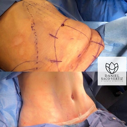 abdominoplastia peru