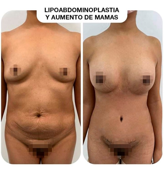 lipoabdominoplastia surco lima