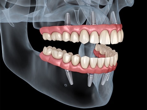 all on 4 all on six implantes dentales