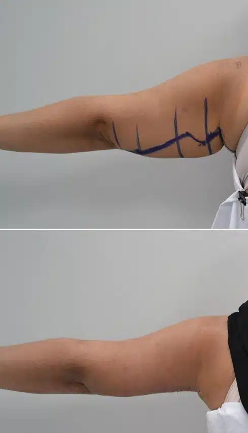 arm lift surgery lima