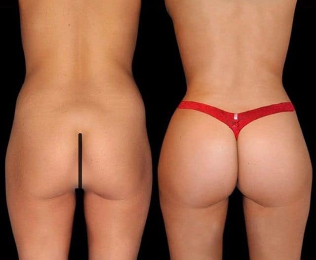 aumento de gluteos BBL lima