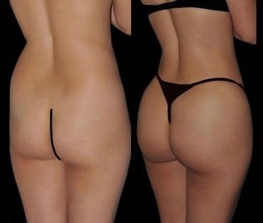 Gluteoplastia en Lima