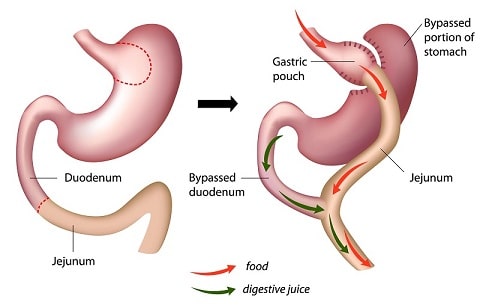 bypass gastrico