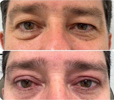 Facial Plastic Surgery Blepharoplasty