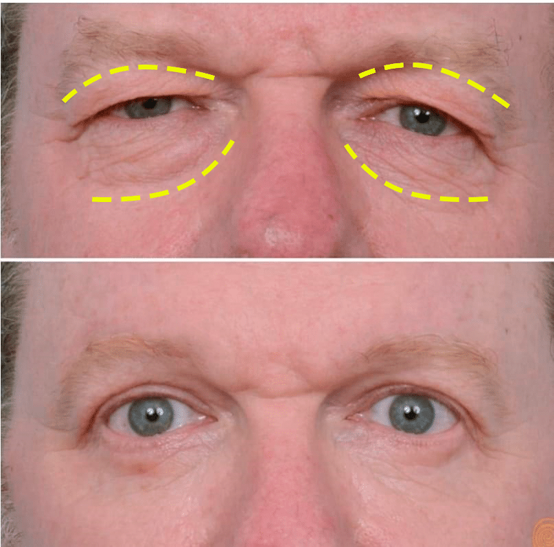 Blefaroplastia cirugía de párpados