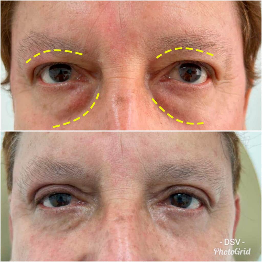 blepharoplasty lima peru
