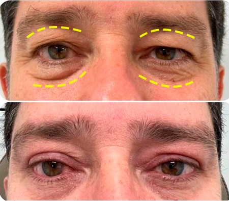 Blefaroplastia cirugía de párpados