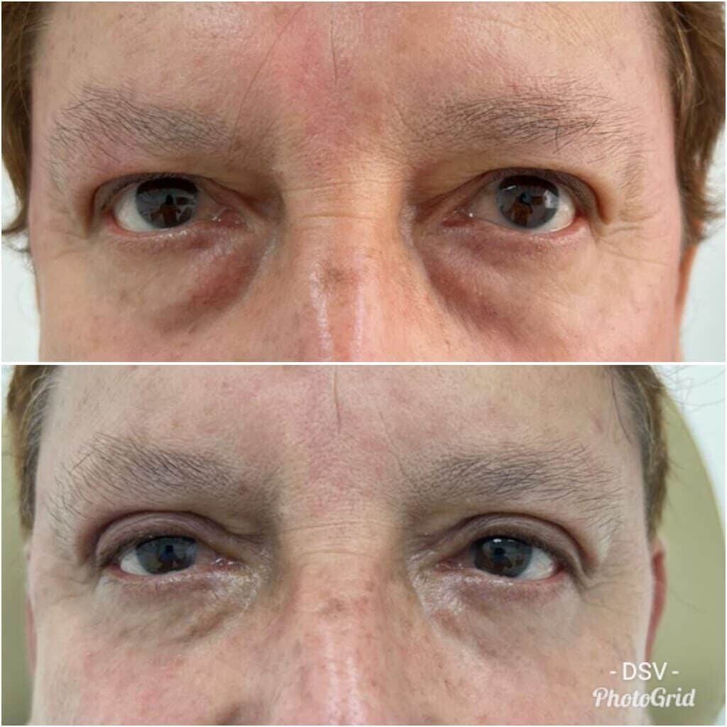 Blepharoplasty lima peru