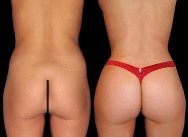 Tummy Tuck & BBL