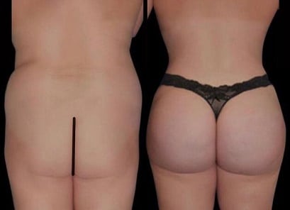 Body Contouring Lima