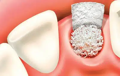 Bone graft small bone graft