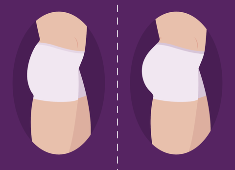 implantes de glúteos en hombres en Lima, Perú