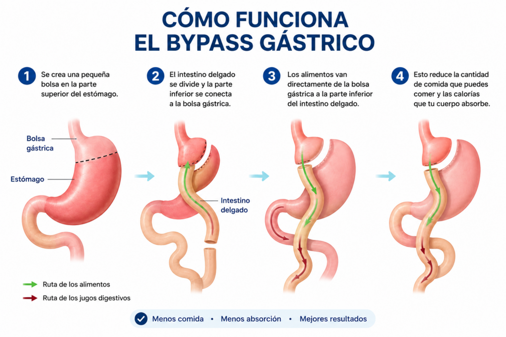 Bypass Gastrico como funciona con el Dr Renato Landa