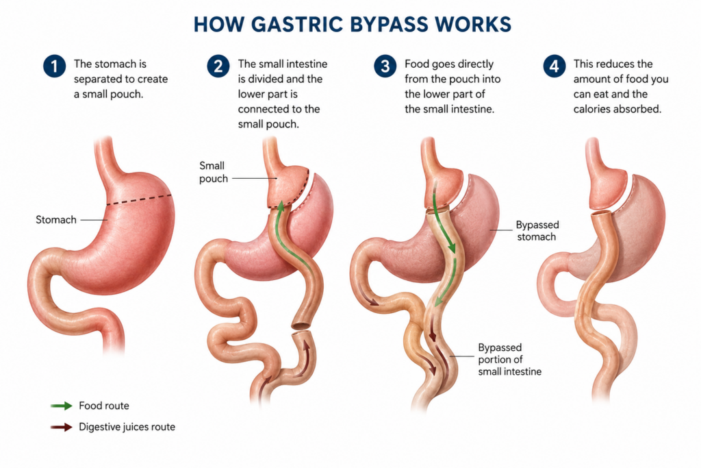 Bypass Surgery in Lima Peru