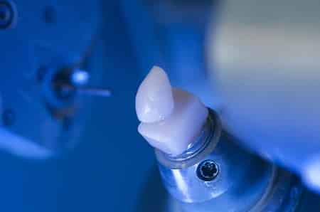 CEREC 3D CAD CAM Dental Restorations in Lima - SurgeryinPeru