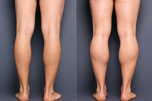 calf implants in lima peru
