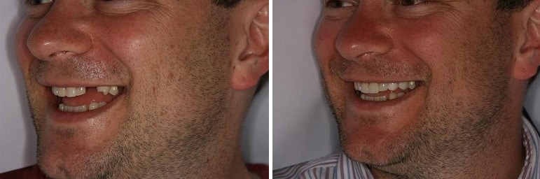 dental implants
