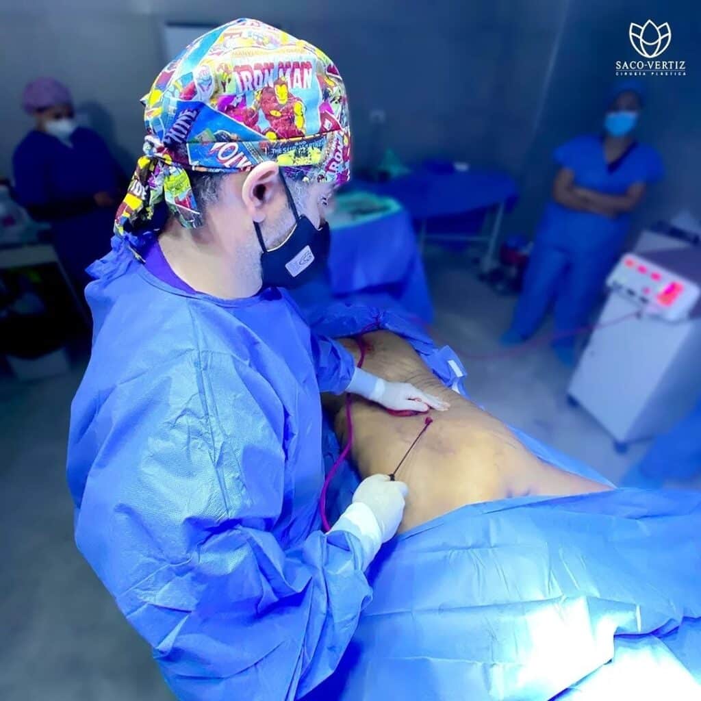 high definition liposuction in Lima