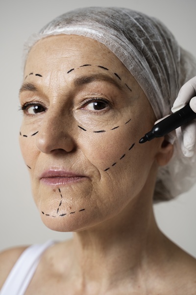 facial fat graft face 