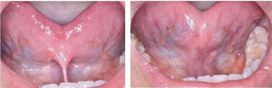 frenectomy lima peru