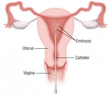 Gamete Intrafallopian Transfer Gamete Intrafallopian Transfer