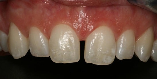 veneers gap close