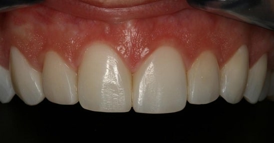 dental veneers after