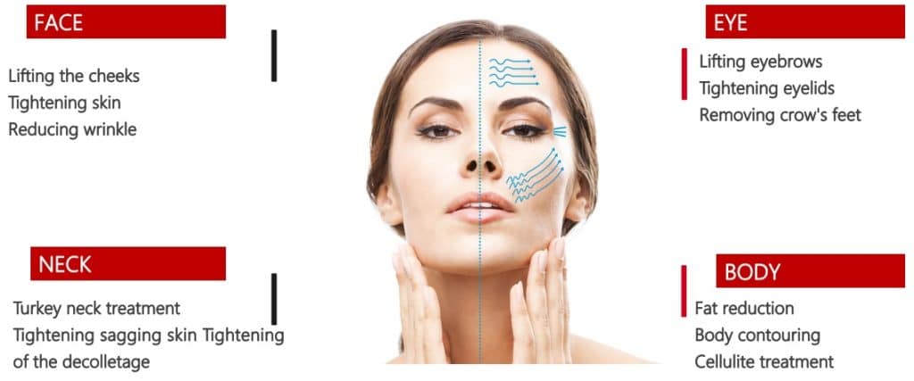 Hifu lifting without surgery