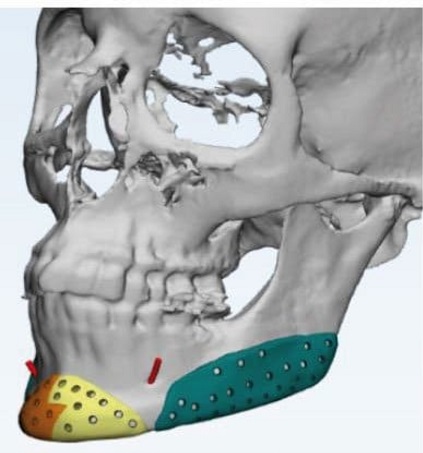 Implantes-Mandibulares Lima