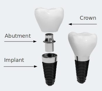 dental implant technology