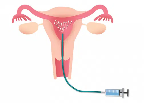 Intrauterine Insemination lima peru Intrauterine Insemination