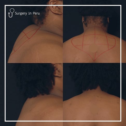 buffalo hump removal