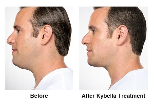 kybella