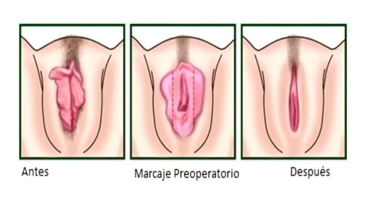 labiaplasty Labiaplasty Vaginal Rejuvenation Treatment in Lima - Surgery in Peru