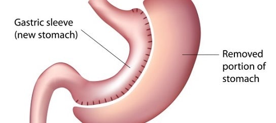 Bariatric Surgery in Lima