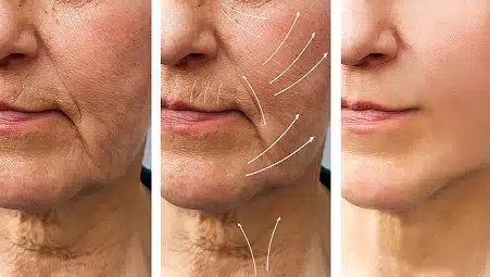 fat transfer facelift