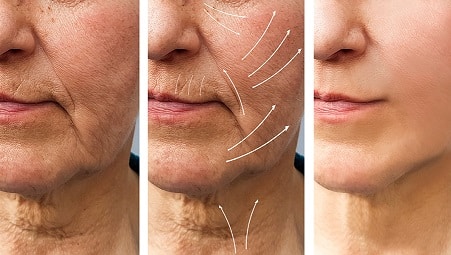 Lifting Facial con Lipotransferencia