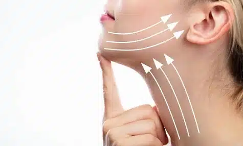 Ultra HIFU Lifting sin cirugía en Lima
