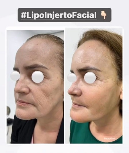 Lipo injerto facial