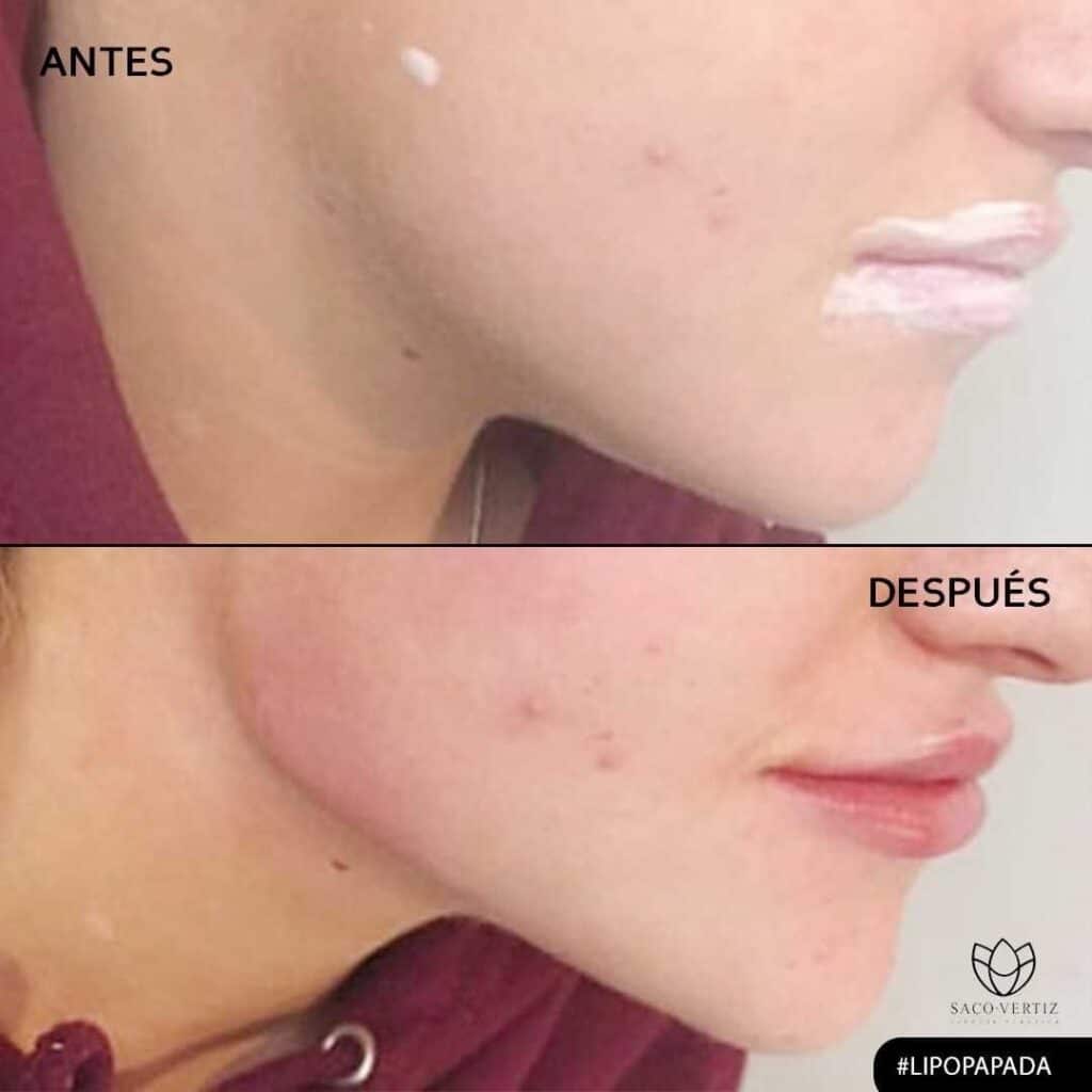 lipopapada