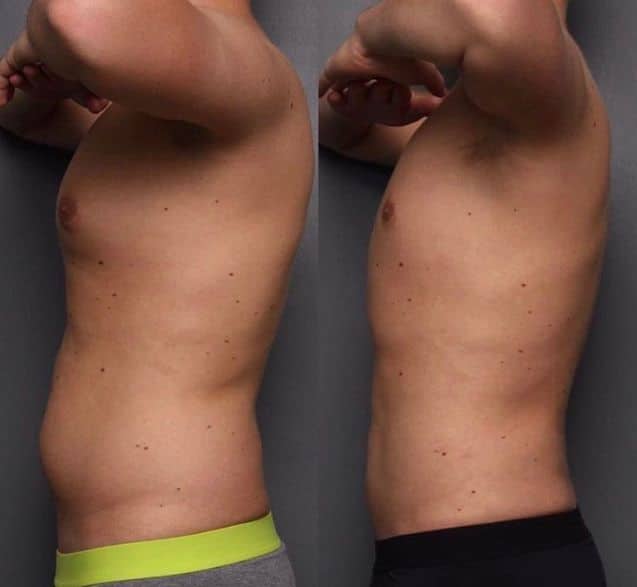 Liposuccion daddy makeover lima
